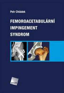 Femoroacetabulární impingement syndrom