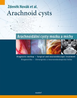 Arachnoidální cysty mozku a míchy