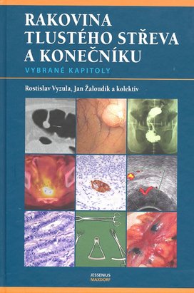 Rakovina tlustého střeva a konečníku