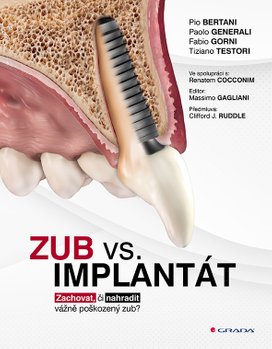 Zub vs. implantát