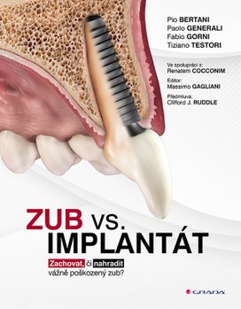 Zub vs. implantát